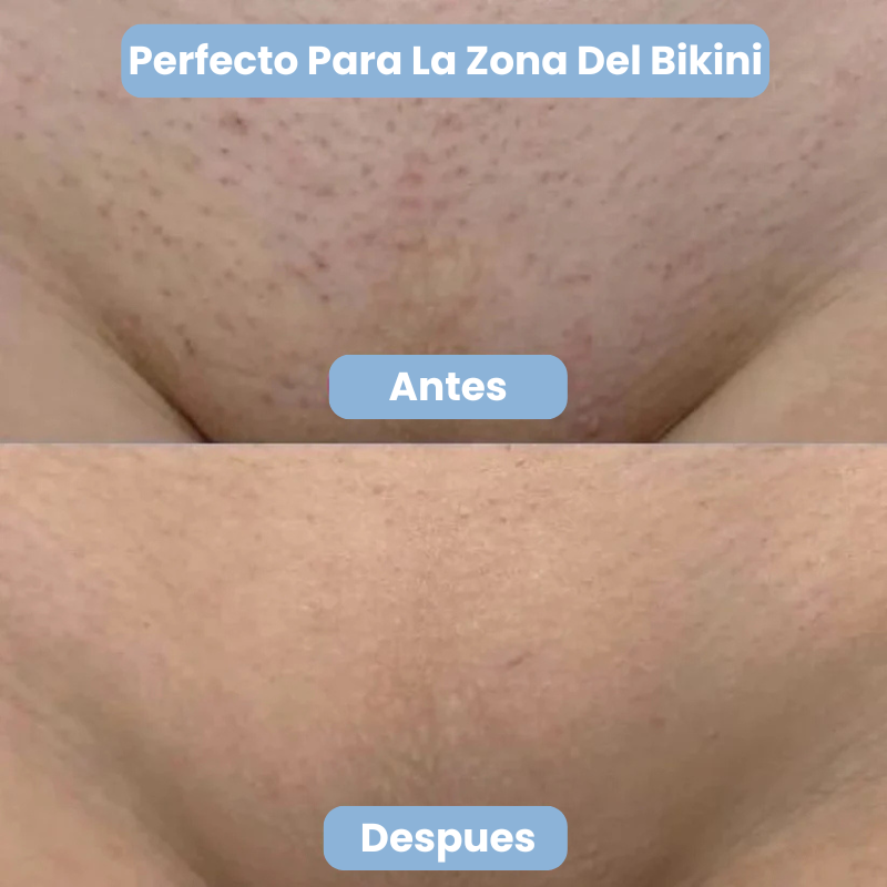 Lumi™ Roll On Anti Vellos Encarnados y Manchas