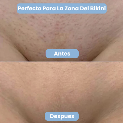 Lumi™ Roll On Anti Vellos Encarnados y Manchas