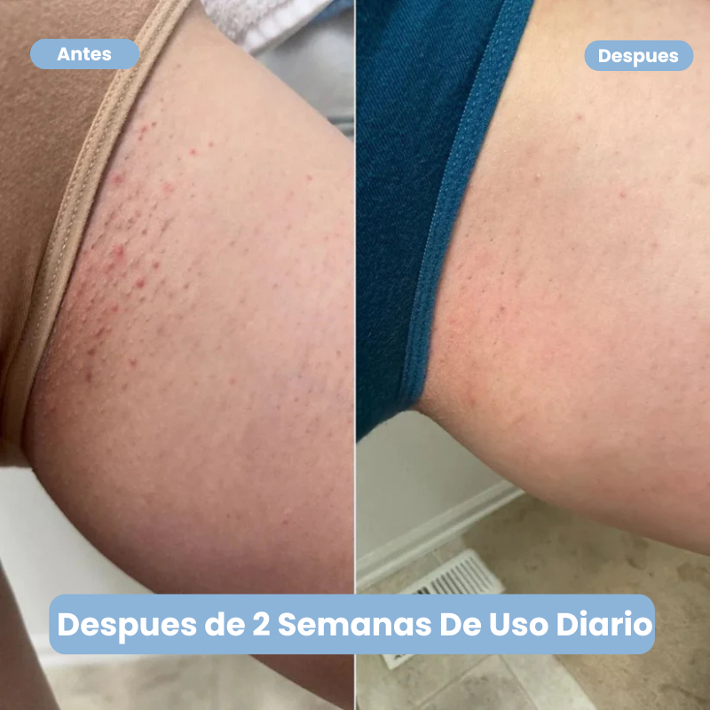 Lumi™ Roll On Anti Vellos Encarnados y Manchas